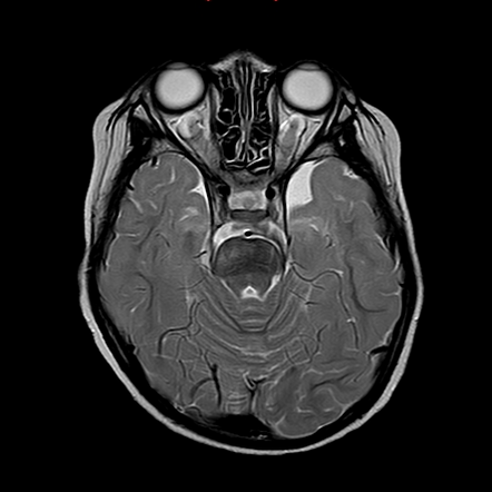 Optic pathway glioma | Radiology Case | Radiopaedia.org