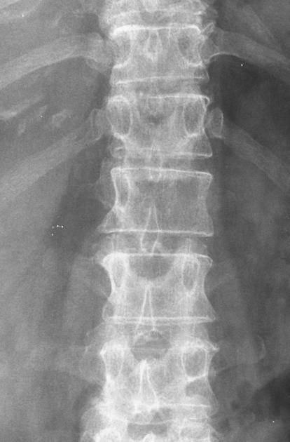 Winking owl sign (spine) | Radiology Reference Article