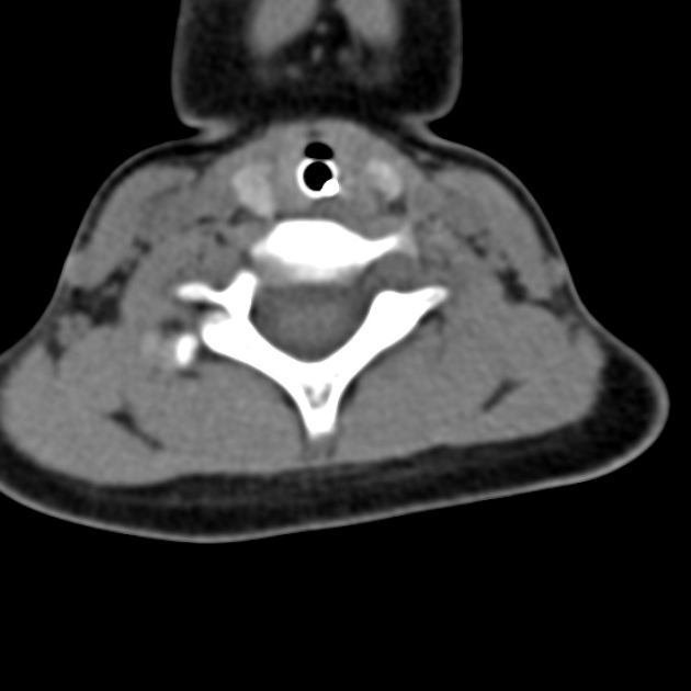 CT cervical spine (protocol)  Radiology Reference Article