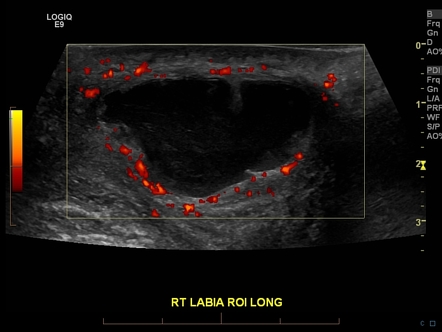 Bartholin Gland Cyst Mri