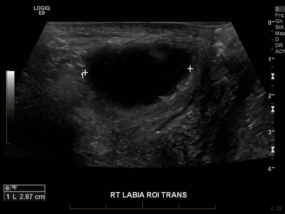 Bartholin gland abscess | Image | Radiopaedia.org