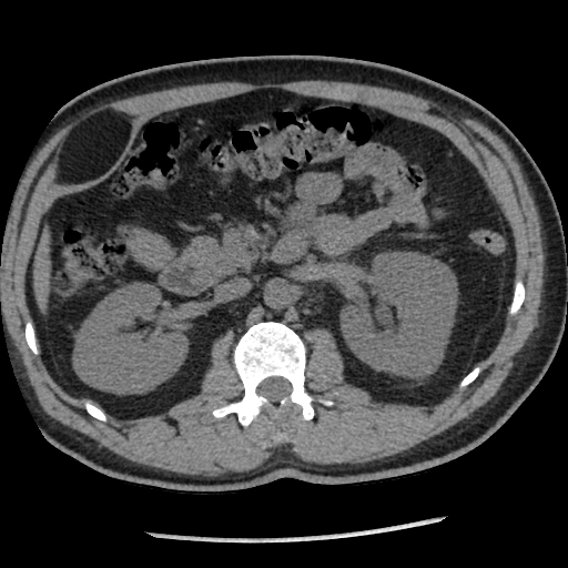 Anterior Abdominal Wall Intermuscular Lipoma Image 3080