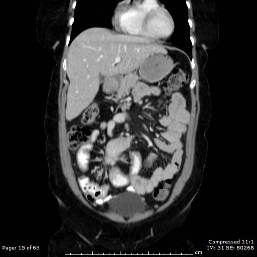 Carcinoid syndrome | Image | Radiopaedia.org