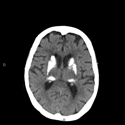 Fahr disease | Image | Radiopaedia.org