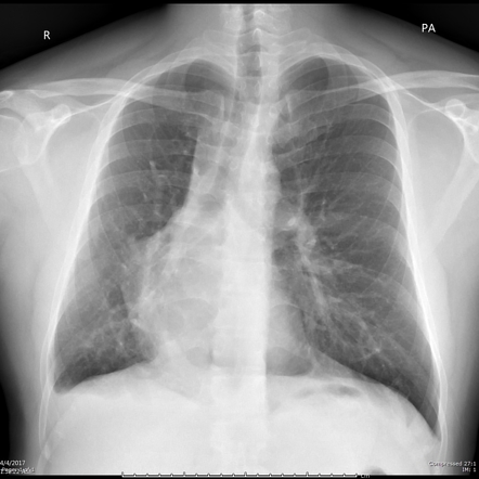 Infracardiac partial anomalous pulmonary venous return (scimitar ...