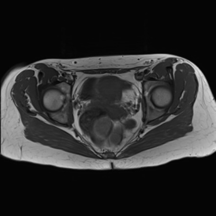 Tailgut duplication cyst | Image | Radiopaedia.org