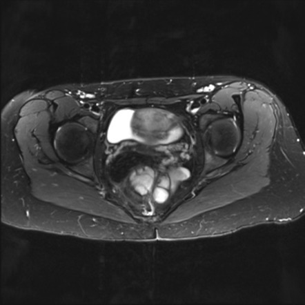 Tailgut cyst | Radiology Reference Article | Radiopaedia.org