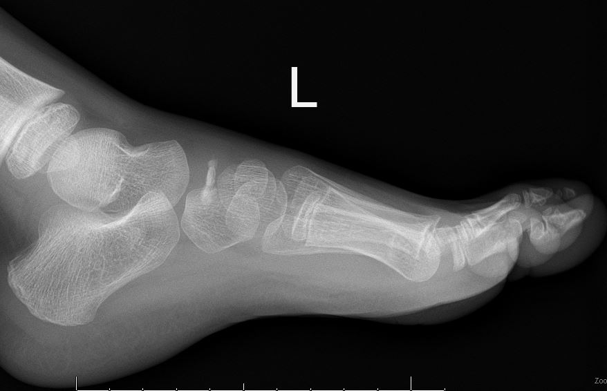 Navicular avascular necrosis (Köhler disease) | Image | Radiopaedia.org