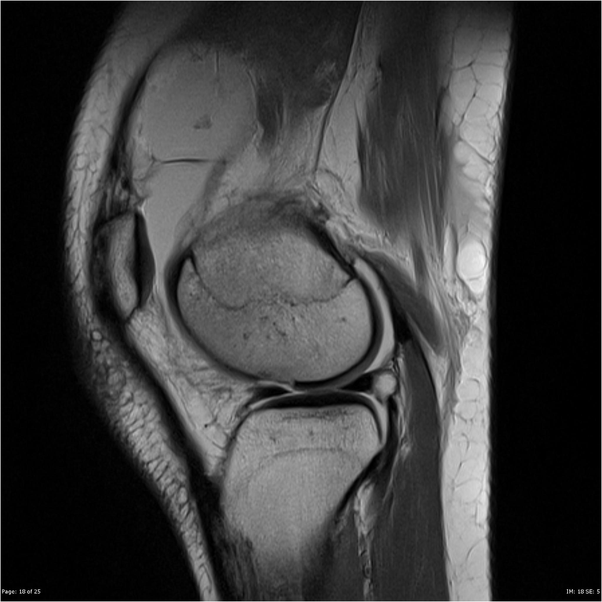 Lateral Femoral Condyle Fracture