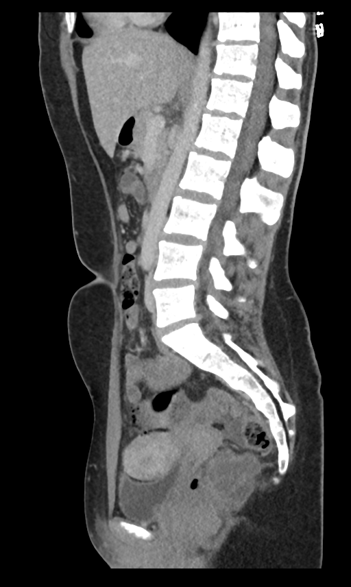 Tailgut duplication cyst | Image | Radiopaedia.org