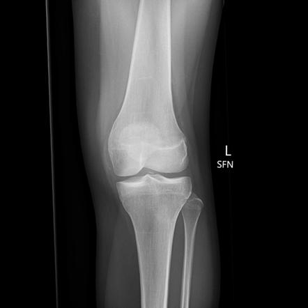 Osteochondral fracture - lateral femoral condyle | Image | Radiopaedia.org