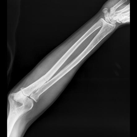 Ulnar fracture | Radiology Case | Radiopaedia.org