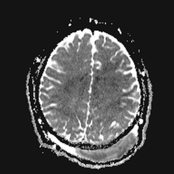 Subgaleal abscess with small epidural abscess | Image | Radiopaedia.org