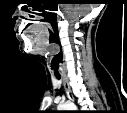 Thyroglossal duct cyst | Radiology Reference Article | Radiopaedia.org