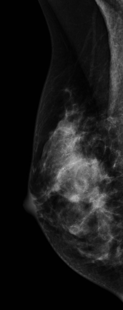 Breast Cancer Malignant Calcification Mammography Radiology Case Radiopaedia Org