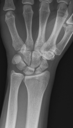 Scaphoid fracture | Radiology Reference Article | Radiopaedia.org