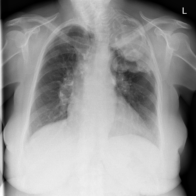 Thoracic plombage | Image | Radiopaedia.org