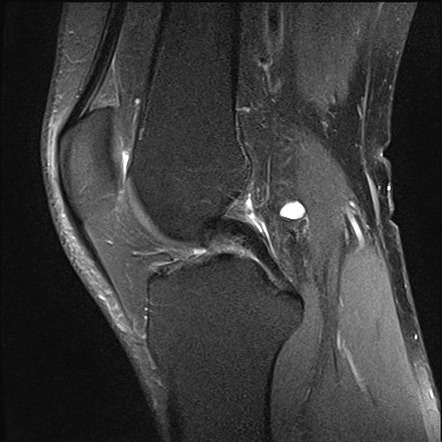 Cystic Adventitial Disease Of The Popliteal Artery 