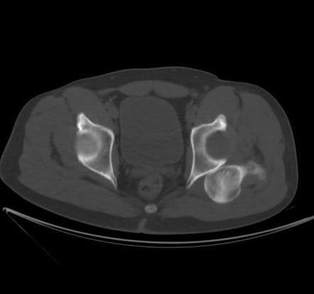 Posterior Hip Dislocation 