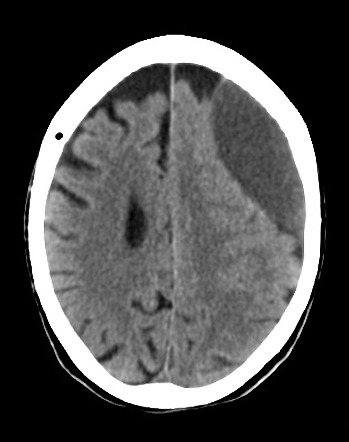 Acute On Chronic Subdural Haematoma Radiology Case Radiopaedia Org