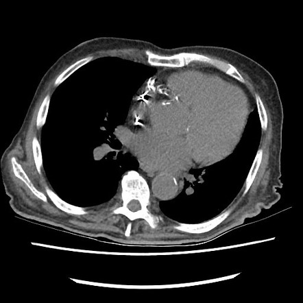 Skin fold mimicking pneumothorax | Image | Radiopaedia.org