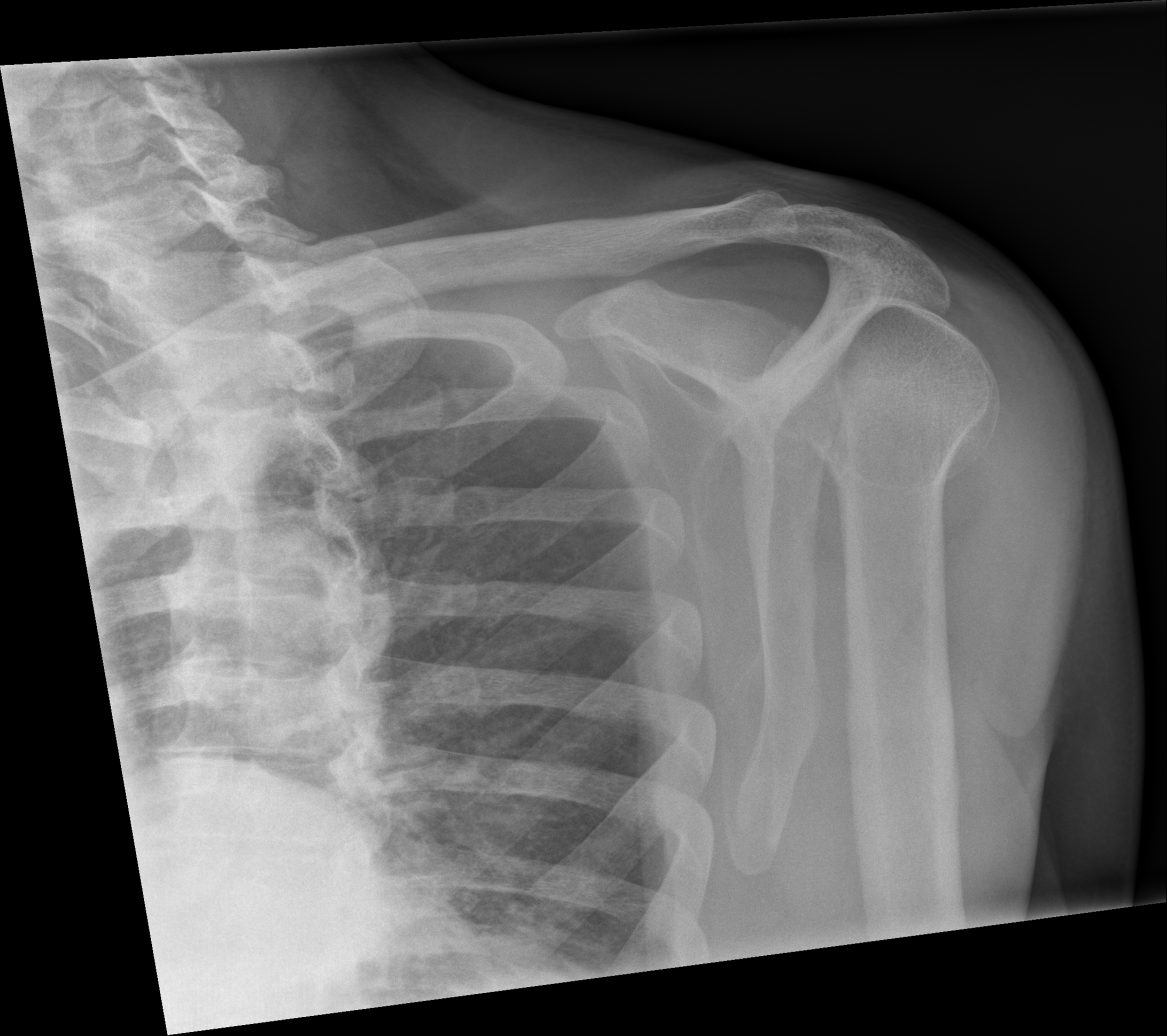 X Ray Of Shoulder Labeled at Janice Bowen blog