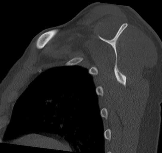 Lesser Tuberosity Fracture