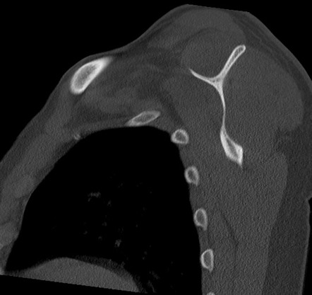 Posterior shoulder dislocation with lesser tuberosity fracture | Image ...