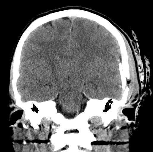 Depressed Skull Fracture With Extradural Hematoma | Image | Radiopaedia.org