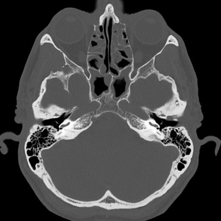 Symptomatic foramen tympanicum | Image | Radiopaedia.org