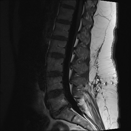 Conjoined nerve root | Image | Radiopaedia.org