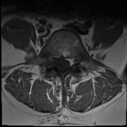 Conjoined nerve root | Image | Radiopaedia.org