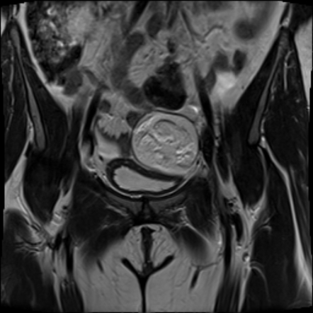 Ovarian Cyst CT Scan