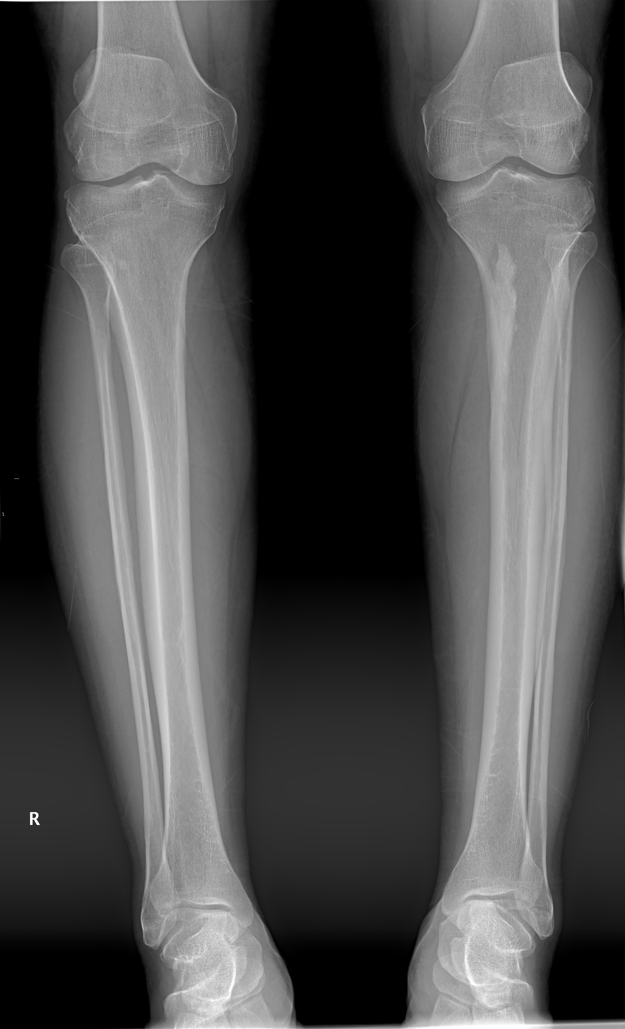 Melorheostosis in left tibia | Image | Radiopaedia.org