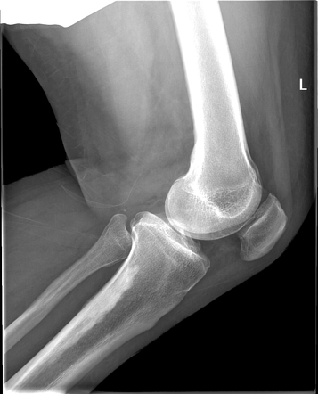 Melorheostosis in left tibia | Image | Radiopaedia.org