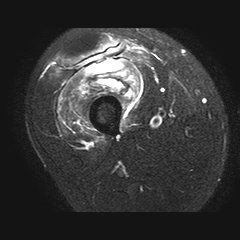 Vastus intermedius muscle partial tear | Image | Radiopaedia.org