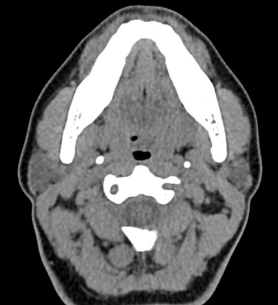 Wharton's duct stone | Image | Radiopaedia.org