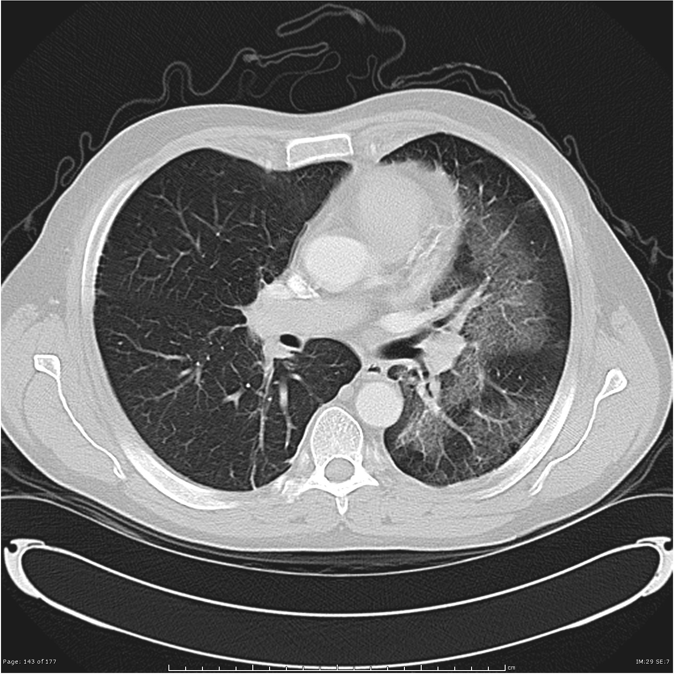 Radiology Quiz 21993 | Radiopaedia.org