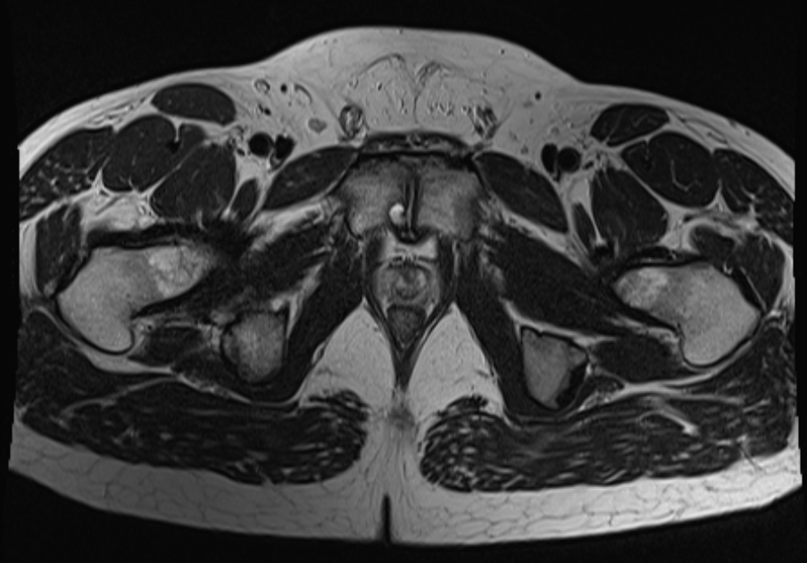 Osteitis Pubis Image