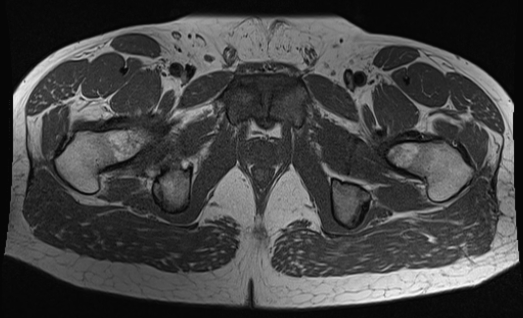 Osteitis Pubis Image