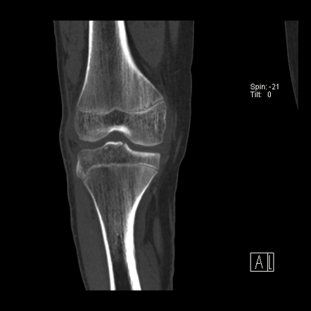 Anterior cruciate ligament avulsion fracture | Radiology Case ...