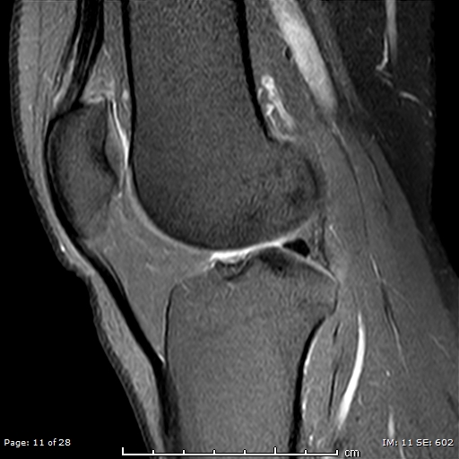 Quadriceps Fat Pad Impingement Syndrome Image