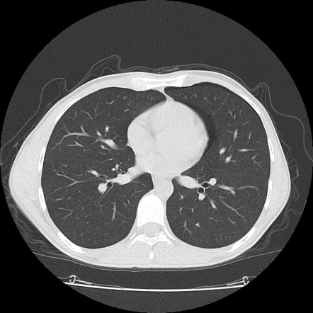 Spontaneous Pneumothorax | Radiology Case | Radiopaedia.org