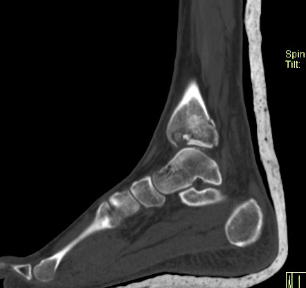 Pilon Fracture | Radiology Case | Radiopaedia.org