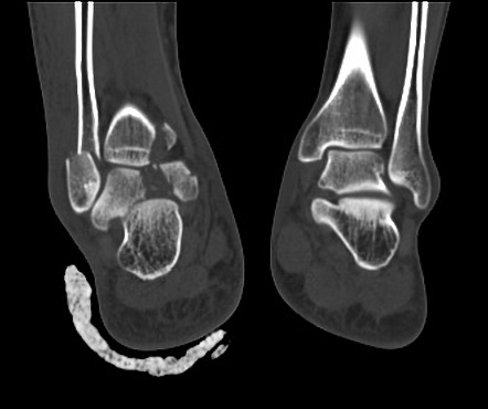 Weber B Ankle Fracture And Extra-articular Calcaneal Fracture ...