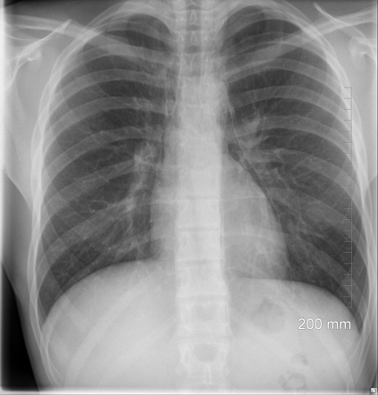 Pneumomediastinum | Radiology Case | Radiopaedia.org