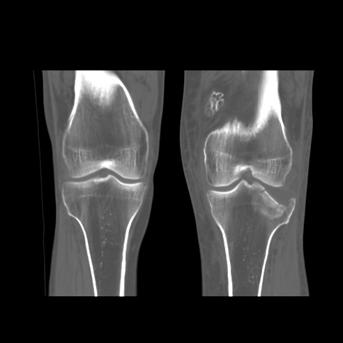 Diaphyseal Aclasis And Tibial Plateau Fracture | Image | Radiopaedia.org