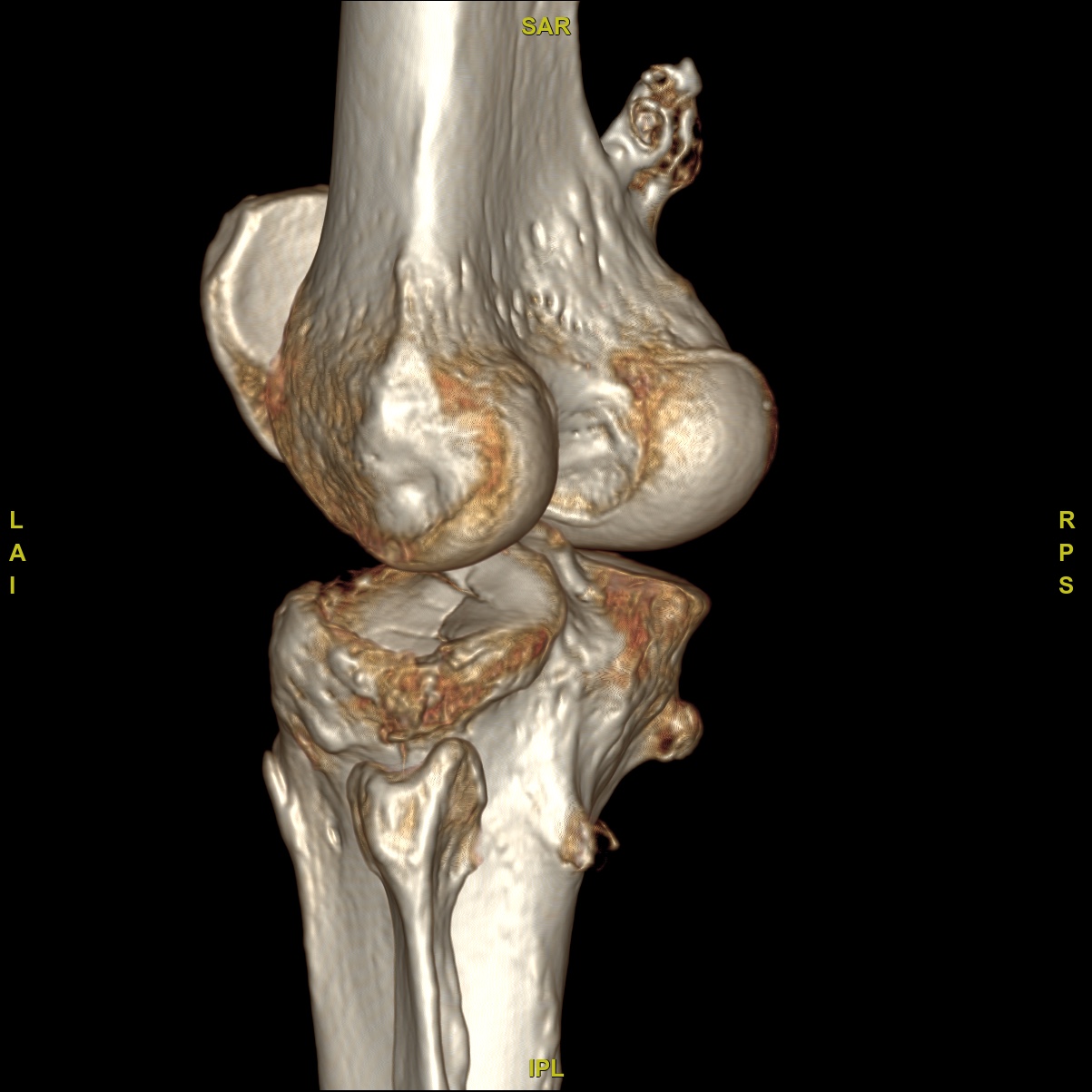 Modality: CT (3D VRT) 