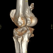 Schatzker Classification Of Tibial Plateau Fractures