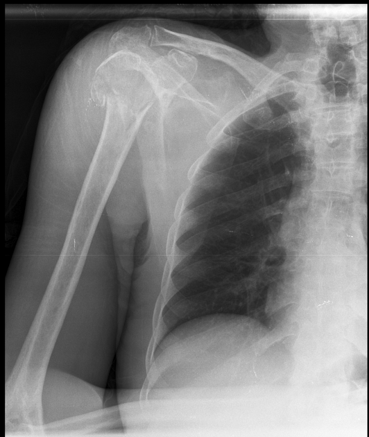 Proximal humeral fracture (summary)